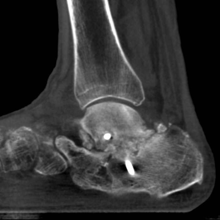 Case 1 Lateral XRay